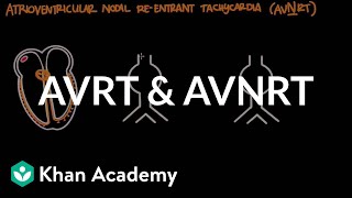 Atrioventricular reentrant tachycardia AVRT amp AV nodal reentrant tachycardia AVNRT [upl. by Drona]