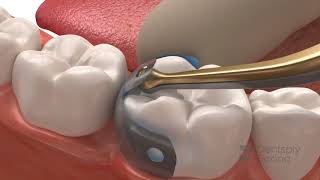 Palodent V3 EZ Coat  Dentsply Sirona [upl. by Malka]