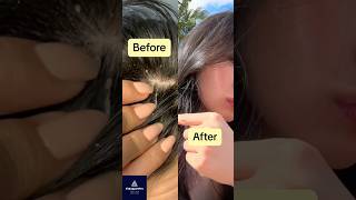 Automatic Scalp Massager is Essential for Hair Growth amp Thickness [upl. by Aiciles435]