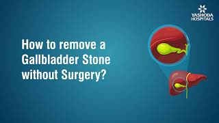 How to remove Gallbladder Stone without surgery [upl. by Ainslie]