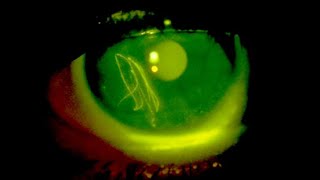 Fluorescein eye stain [upl. by Emalia]