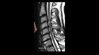 Cervical Spondylosis MRI Analysis shorts [upl. by Nereus151]