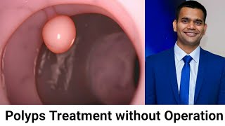 Polyps  Treatment Without Operation and Causes [upl. by Leis]