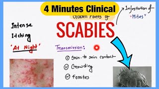 Scabies Spot Diagnosis and Prescription  Symptoms Pathogenesis Treatment  4 Minutes Clinical [upl. by Calie153]