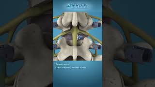 What is Posterior Lumbar Interbody Fusion  PLIF Shorts [upl. by Ennovy]