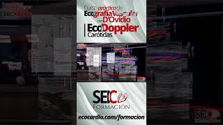 Curso Práctico de Ecografía Vascular  Eco Doppler Carótidas [upl. by Zicarelli12]