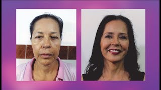 LIFTING FACIAL 👸 REJUVENECIMIENTO FACIAL ANTES y DESPUES 💕CIRUGÍA PLASTICA NEVADO 💜 Dr Percy Nevado [upl. by Hessler328]