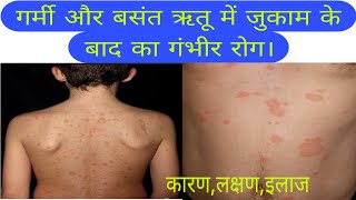 जुकाम के बाद छाती और पीठ का गंभीर रोग कारण इलाज pityriasis rosea disease causessymptomstreatment [upl. by Greff]