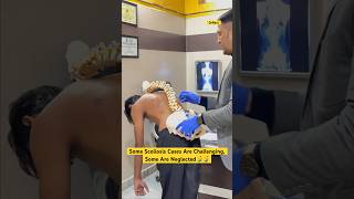 Rare Kyphoscoliosis case treatment by DrRavi kyphosis scoliosistreatment spine chiro reels [upl. by Christalle]