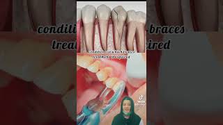 Conditions in which we require tooth extraction dentist oralhygiene dentista pain orthodontics [upl. by Nino496]