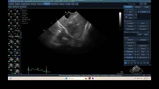 IQ 298 TFAST LUNG MEDIASTINAL LYMPHOID NODE ENLARGEMENT HWD ECHOPAC ANALYSIS [upl. by Della]