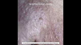 HPV warts Imiquimod and burning and podophyllin failed treatment  10 years of infection [upl. by Yelyac]