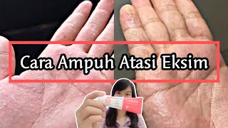 AKHIRNYA NEMU SKINCARE YANG AMPUH ATASI EKSIMKU‼️  EKSIM DISHIDROSIS  POMPHOLYX [upl. by Luzader427]