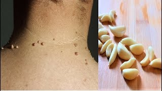 Remove Skin Tags  Home Remedies To Remove Skin Tags Easily [upl. by Danette]