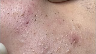 Acne treatment for Spa Linh Mun 2023 003 [upl. by Ikiv62]