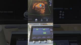 Testicular Torsion  Early Subacute Stage  Ultrasound [upl. by Reinhard606]