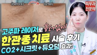 획기적인 최신 레이저로 흉터 없이 한관종 치료 QnA🙌ㅣ노남경의 피부클래스 [upl. by Ardnuyek]