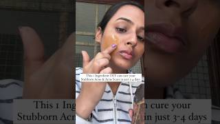 Acne Treatment at home  Remove Acne amp Acne Scars at home  Pimples treatment at home acnetreatment [upl. by Arrais]