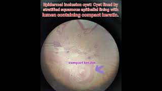 Epidermal inclusion cysthistologyskinpathologymedical [upl. by Carlynne]