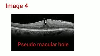 OCT MACULA Image quiz with explanation  Optometry Tamil  Made easy [upl. by Anyl]