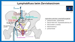 Lymphabfluss beim Zervixkarzinom  Strahlentherapie Prof Hilke Vorwerk [upl. by Hedgcock]