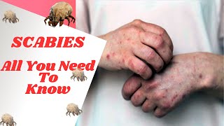 How To Identify amp Treat Scabies Causes Symptoms Prevention  Permethrin Ivermectin [upl. by Fougere]