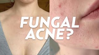 What is Fungal Acne We Discuss Skincare Treatments Causes amp More [upl. by Sidnak813]