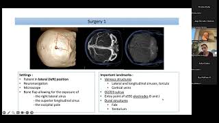 ESTMIESS Global Epilepsy Surgery Technique Rounds [upl. by Neemsaj]