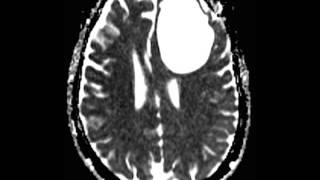 Neuroepithelial Ependymal Cyst [upl. by Ailel]