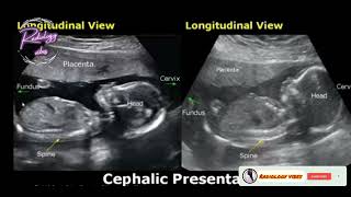 Breech BabyBaby presentation on ultrasound [upl. by Dorrehs]