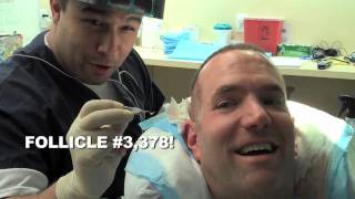 HAIR TRANSPLANT FUN [upl. by Aneez]