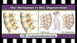 HCPCS and CPT Codes FAQs  Disc Herniation vs Disc Degeneration [upl. by Menzies]