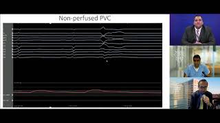 Complex PVC Ablation  Tips and Tricks for Success [upl. by Htiduy]