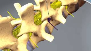 What to expect during a Nerve Root Block at RAYUS [upl. by Rimisac]