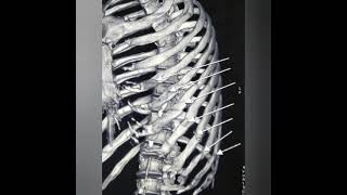 INTERCOSTAL DRAINAGE FOR HEMOTHORAX [upl. by Tanner]