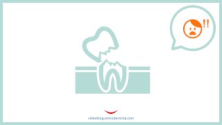 Denti che si rompono in seguito a devitalizzazione [upl. by Kohcztiy]