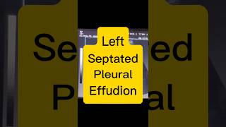 Septated Pleural Effusion  Lung Fluid  Dyspnoea ultrasound [upl. by Sonahpets474]