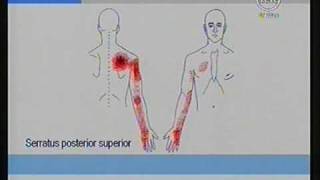 Dolores de los brazos originados por Nódulos Dolorosos Trigger Points  Dr Isaac Jakter [upl. by Gower]