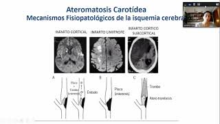 Ateromatosis carotidea [upl. by Foscalina211]