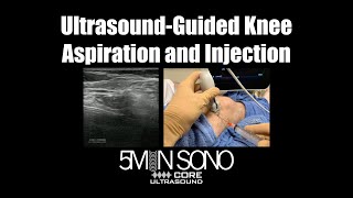 UltrasoundGuided Knee Aspiration and Injection A StepbyStep Guide [upl. by Latsryk481]