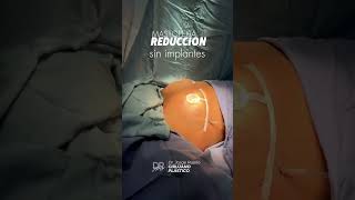 Mastopexia de reducción sin implantes bydoctorpuello [upl. by Beniamino]