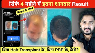 Hair Regrowth Result in 4 Months बिना Hair Transplant के। [upl. by Theadora]