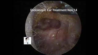 Two cases of middle ear cholesteatoma with postoperative debridement [upl. by Cynara]