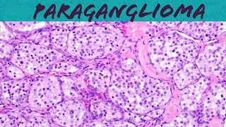 Paraganglioma carotid body tumor amp Pheochromocytoma explained in 5 minutes pathology USMLE [upl. by Jezrdna847]