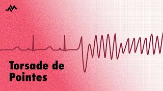 Torsade de Pointes  EKG ECG Interpretation [upl. by God400]