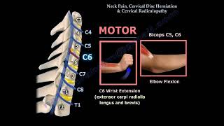 Neck Pain Cervical Disc Herniation amp Radiculopathy [upl. by Richman663]