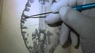 NEUROANATOMIA 20 Corte Horizontal por arriba del Cuerpo Calloso Vieussens Esquema 2 [upl. by Euqinemod]