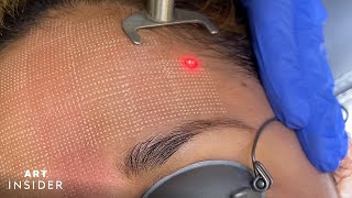 Minimize Acne Scarring With Laser Resurfacing [upl. by Joed]