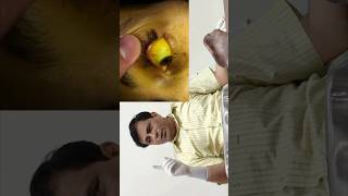 Icterus examination how to check icterus in eye in a jaundice patient shorts [upl. by Ljoka]