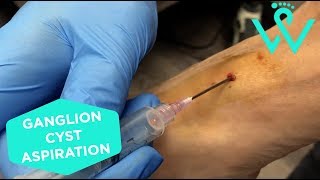 Ganglion Cyst Aspiration [upl. by Wolfort]